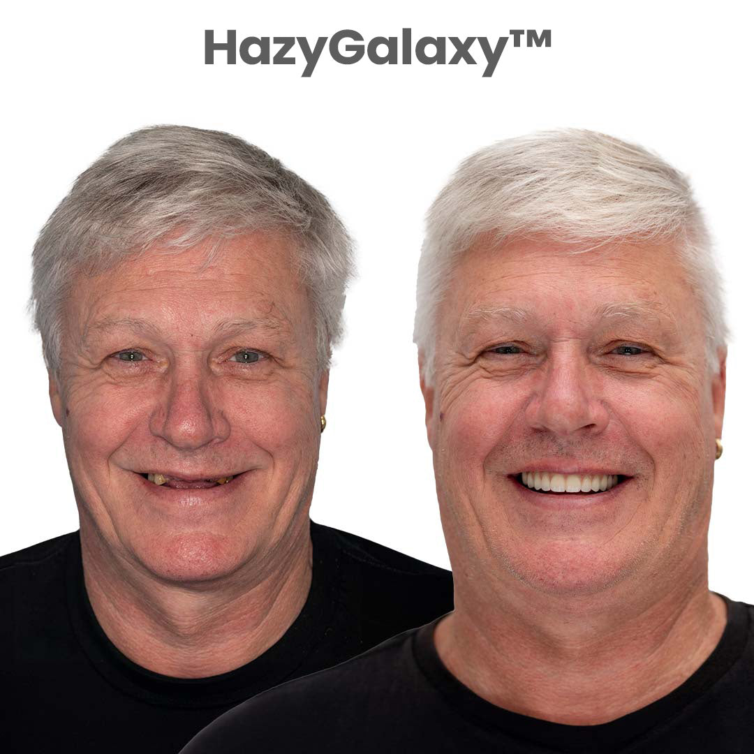 🔥 ENDS TODAY 80% OFF🔥 HazyGalaxy™ Custom-Fit Dentures 🦷Smile with Confidence