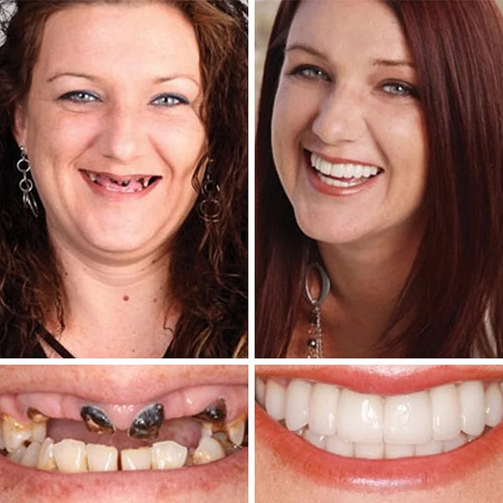 '--Ends Today: 75% OFF! ⏰DarkFairy™ Medical Full Denture with Strong Suctiond Custom-Fit Full Functional Dentures🦷